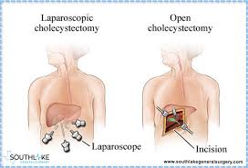 laparoscopic gallbladder surgery bile