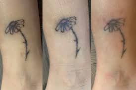 Generally, amateur or homemade tattoo may be removed within 3 to 7 sessions, while professional tattoos done with harder inks can require anywhere from 8 to 20 treatments. Laser Tattoo Removal What To Expect My Experience Hypebae