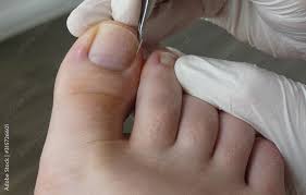 podiatry chiropodist cal foot