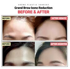 brow bone reduction