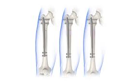 precice nail for bone breaking during