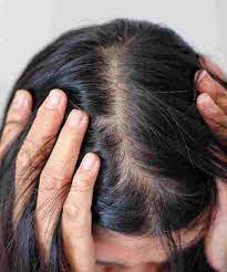 hormones cause hair loss in females