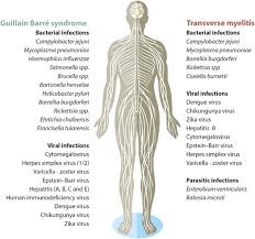 Typically, both sides of the body are involved, and the initial symptoms are changes in sensation or pain often in the back along with muscle weakness. Guillain Barre Syndrome Transverse Myelitis And Infectious Diseases Cellular Molecular Immunology