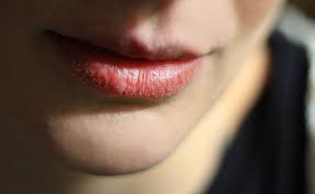 chapped lips how to heal dry ed lips