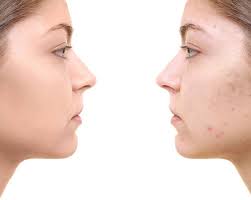 Microneedling devices can help to reduce signs of aging skin and remove acne scars. How Often Should You Microneedle At Home What Is Too Much