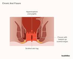 fissure treatment symptoms