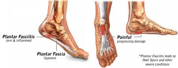 plantar fasciitis remes and