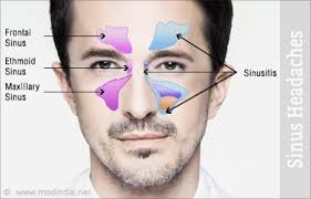 sinus headaches causes symptoms treatment