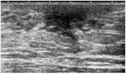 Ultrasound imaging of the breast uses sound waves to produce pictures of the internal structures of the breast. Ultrasound For Breast Cancer Screening Moose And Doc
