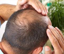 how to regrow hair on bald spot fast