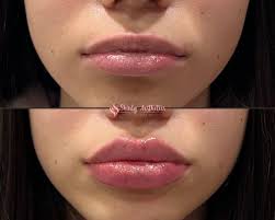 russian lip filler by md 800 book now