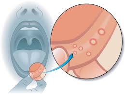 mouth sores pictures types symptoms