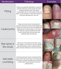 nail matrix psoriatic manifestations