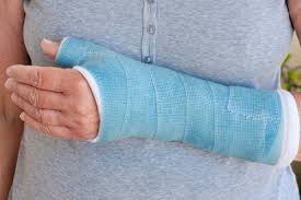how to sd the bone fracture healing