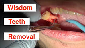 what you should know about wisdom tooth