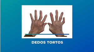 dedos tortos causas e tratamentos