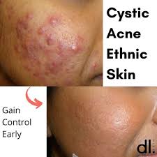 best cystic acne treatments in