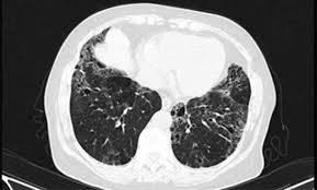 Idiopathic pulmonary fibrosis (ipf) is a chronic and ultimately fatal disease characterized by a is a cytokine released from injured pneumocytes, inducing fibrosis in patients with idiopathic pulmonary. Fibrose Pulmonar O Que E Causas Sintomas Tratamento Cura