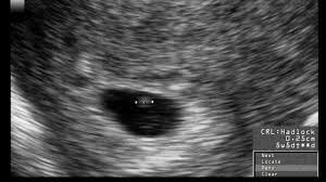 Denkt ihr, dass ist ein embryo? 6 Ssw 6 Schwangerschaftswoche Grosse Entwicklung 9monate De