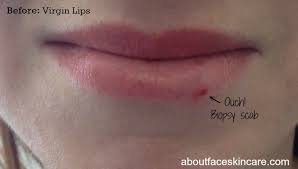 lip injection diary about face