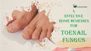 home remes for toenail fungus
