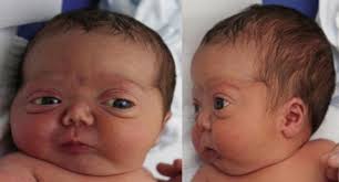 anomalies ociated with cleft palate