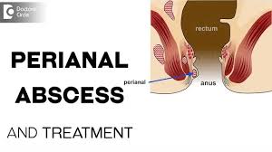 how to treat a peri abscess