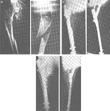 gamma nail in the treatment of closed