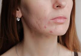 acne after laser hair removal and its