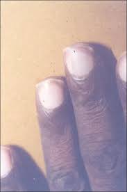 nails in systemic disease indian