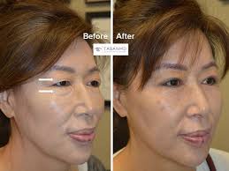 before and after asian blepharoplasty