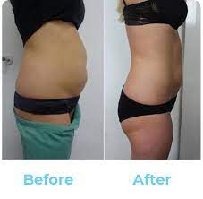 cryotherapy fat reduction body