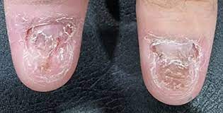 treatment of dystrophic nails