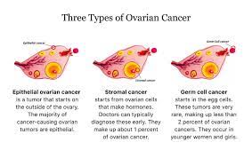 What does a stomach swollen from ovarian cancer look like? Ovarian Cancer Health Guide Symptoms Types Treatment