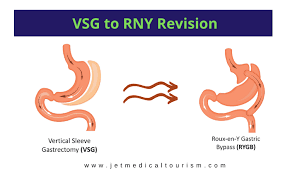 vertical sleeve revision to gastric