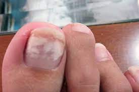 white marks on my toenails