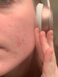 Formation of small hard white small bumps on face or skin falls in to types: Small White Bumps All Over My Cheeks This Is Relatively New Started 3 Mo Ago And I Have No Idea What This Is I Have Tried A Bunch Of Different Products To