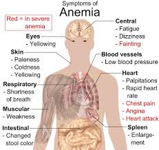Suffering from the Symptoms of Fanconi Anemia which are: - Unexplained  fatigue. - Recurrent colds or viral infections. - Recurrent nosebleeds. -  Easy bruising. - Blood in the stool or urine. -