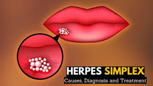 herpes simplex causes signs and