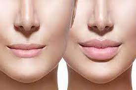 lip augmentation cost in philippines