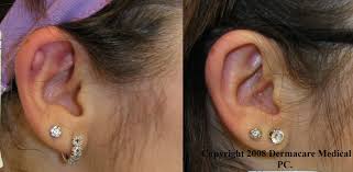 keloid removal and scar treatment