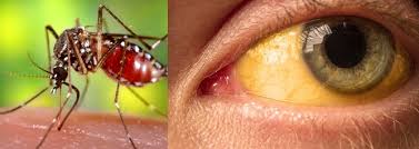 YELLOW FEVER: SYMPTOMS, DIAGNOSIS, TREATMENT AND PREVENTION - Microbiology  Class