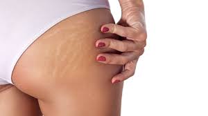 laser to remove stretch marks