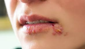 fever blister vs cold sore what s the