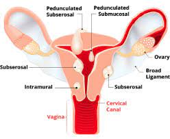 hysterectomies removal of the uterus