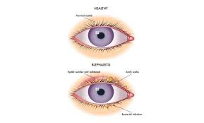 blepharitis and warm compress asia