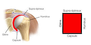 Le tendon le plus fréquemment touché est le supra épineux. Arthro Scanner Le Site De L Epaule