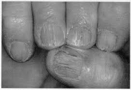 treatment of common nail disorders