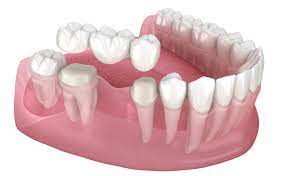 gum pain around a dental bridge