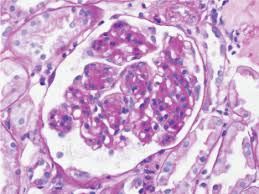 Anti Glomerular Basement Membrane